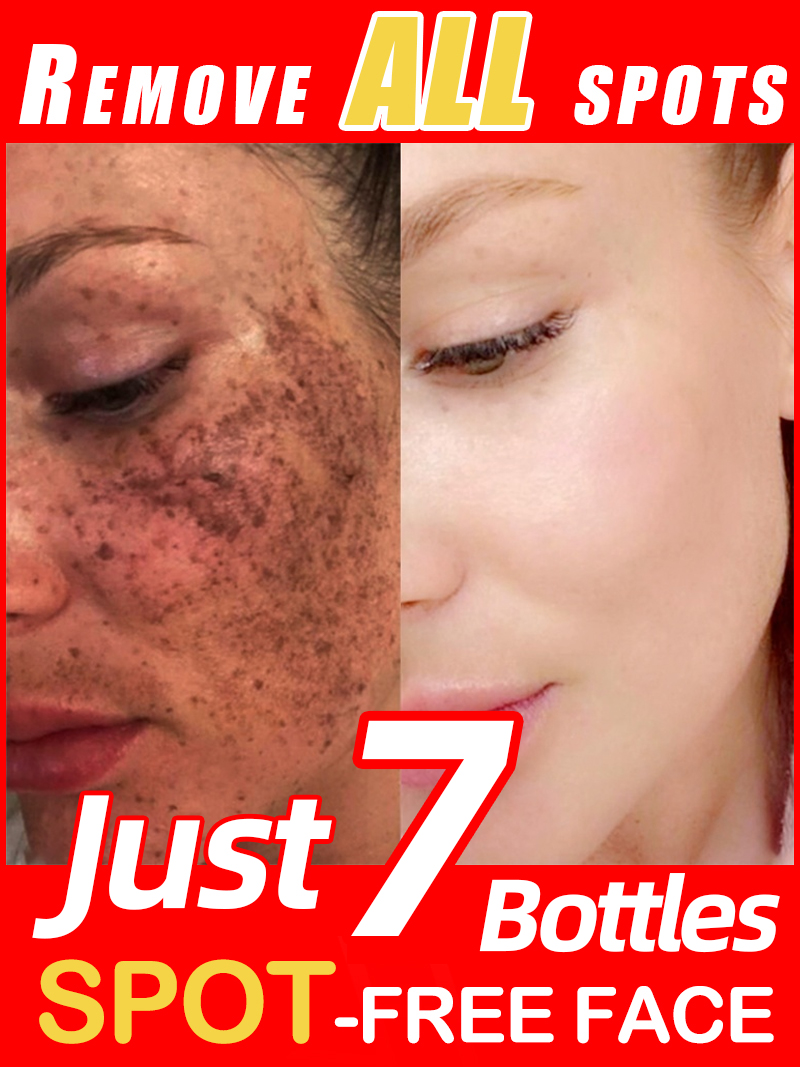 ลดเลือนฝ้า กระ จุดด่างดำบนใบหน - Luxury Skincare Essence บทวิจารณ์และราคา